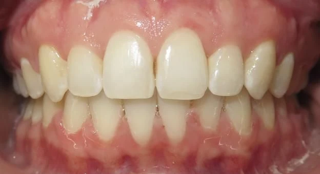 After treatment - Patient 1 orthodontic treatment at Lefort Orthodontics