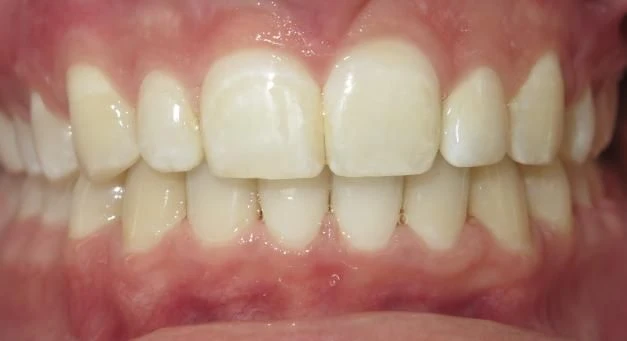 After treatment - Patient 10 orthodontic treatment at Lefort Orthodontics