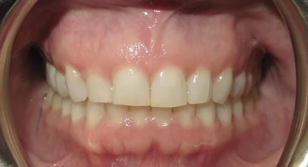After treatment - Patient 11 orthodontic treatment at Lefort Orthodontics