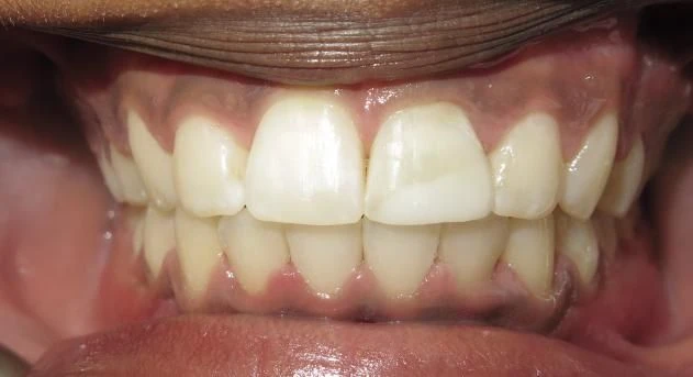 After treatment - Patient 12 orthodontic treatment at Lefort Orthodontics