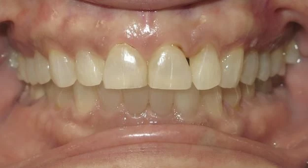 After treatment - Patient 13 orthodontic treatment at Lefort Orthodontics