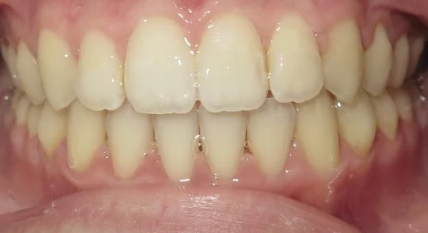 After treatment - Patient 2 orthodontic treatment at Lefort Orthodontics