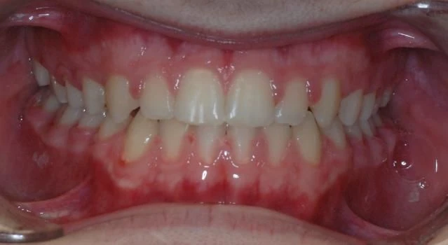 After treatment - Patient 3 orthodontic treatment at Lefort Orthodontics