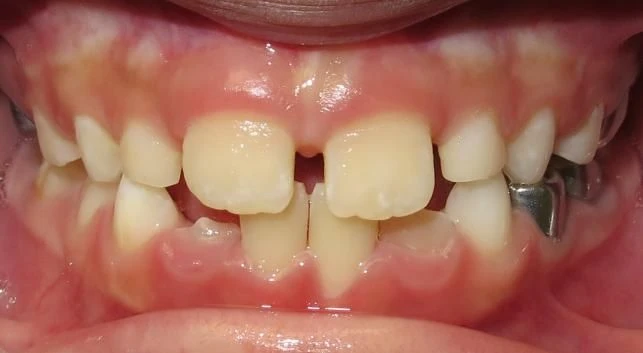 After treatment - Patient 4 orthodontic treatment at Lefort Orthodontics