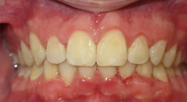 After treatment - Patient 6 orthodontic treatment at Lefort Orthodontics
