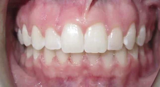 After treatment - Patient 7 orthodontic treatment at Lefort Orthodontics