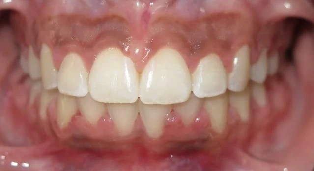 After treatment - Patient 8 orthodontic treatment at Lefort Orthodontics