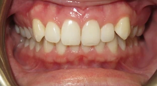 Before treatment - Patient 1 orthodontic treatment at Lefort Orthodontics