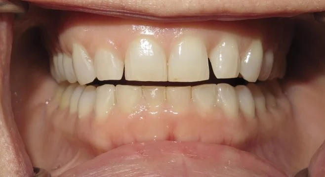 Before treatment - Patient 11 orthodontic treatment at Lefort Orthodontics