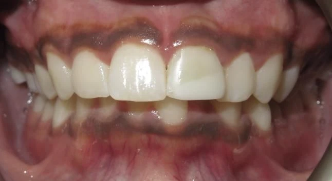 Before treatment - Patient 12 orthodontic treatment at Lefort Orthodontics