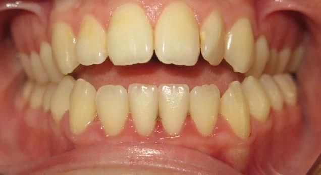 Before treatment - Patient 2 orthodontic treatment at Lefort Orthodontics