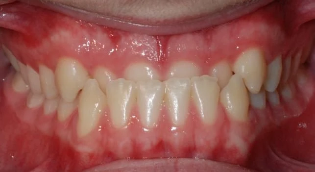 Before treatment - Patient 3 orthodontic treatment at Lefort Orthodontics