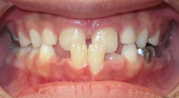 Before treatment - Patient 4 orthodontic treatment at Lefort Orthodontics