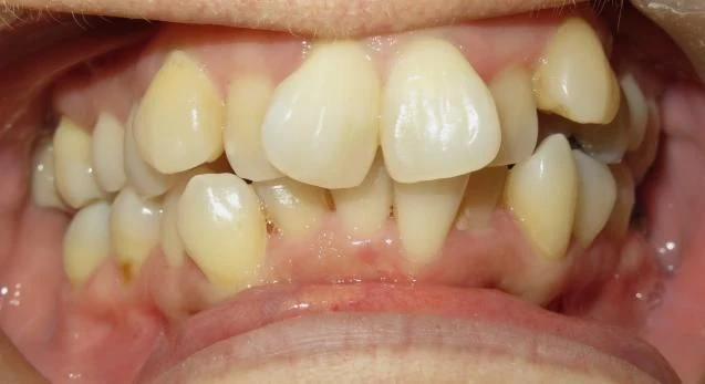 Before treatment - Patient 5 orthodontic treatment at Lefort Orthodontics