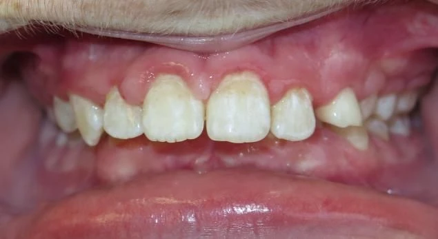 Before treatment - Patient 6 orthodontic treatment at Lefort Orthodontics