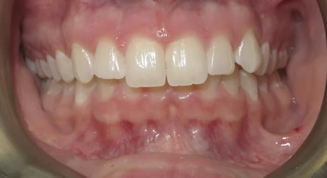 Before treatment - Patient 7 orthodontic treatment at Lefort Orthodontics