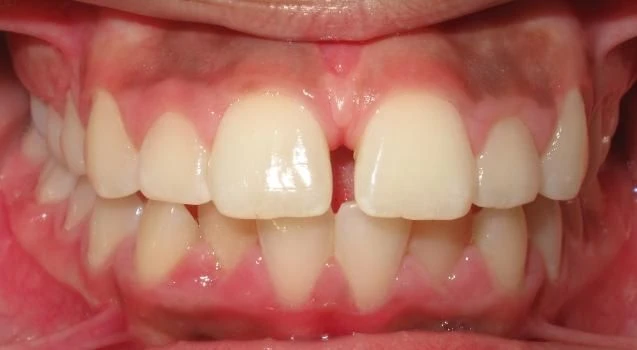 Before treatment - Patient 8 orthodontic treatment at Lefort Orthodontics