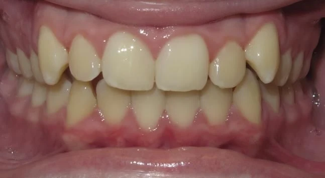 Before treatment - Patient 9 orthodontic treatment at Lefort Orthodontics